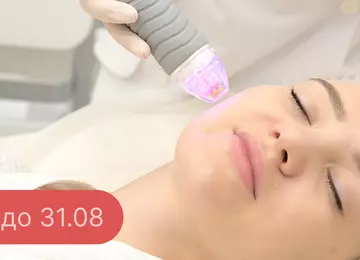 Микроигольчатый RF-лифтинг Vivace